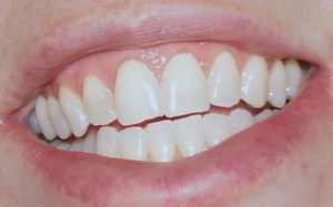 After second treatment