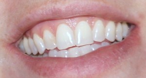 After Fourth Treatment!