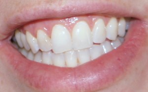 After third treatment