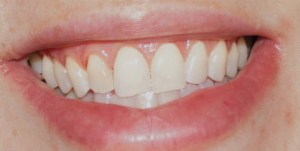 After one treatment.